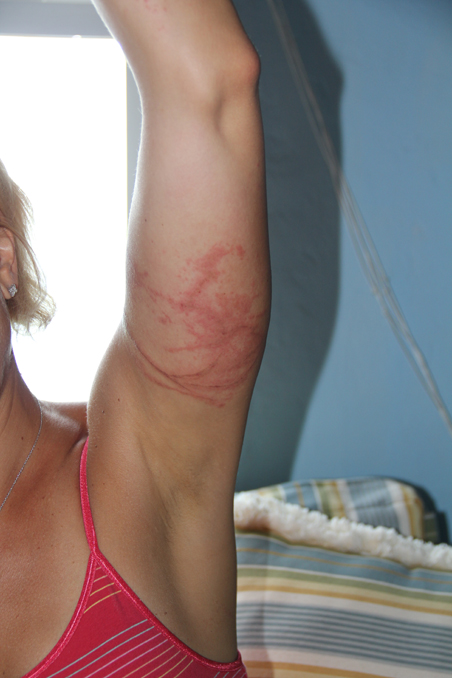 box-jellyfish-sting-2 Melanie Zamichielli's box jellyfish sting