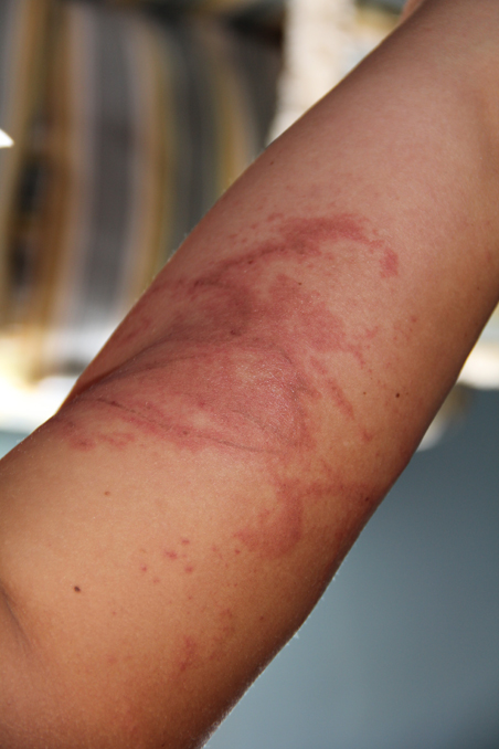 box-jellyfish-sting-3 Melanie Zamichielli's box jellyfish sting, closeup